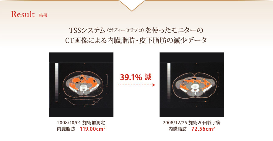 結果
TSSシステム（ボディーセラプロ）を使ったモニターの
CT画像による内臓脂肪・皮下脂肪の減少データ
